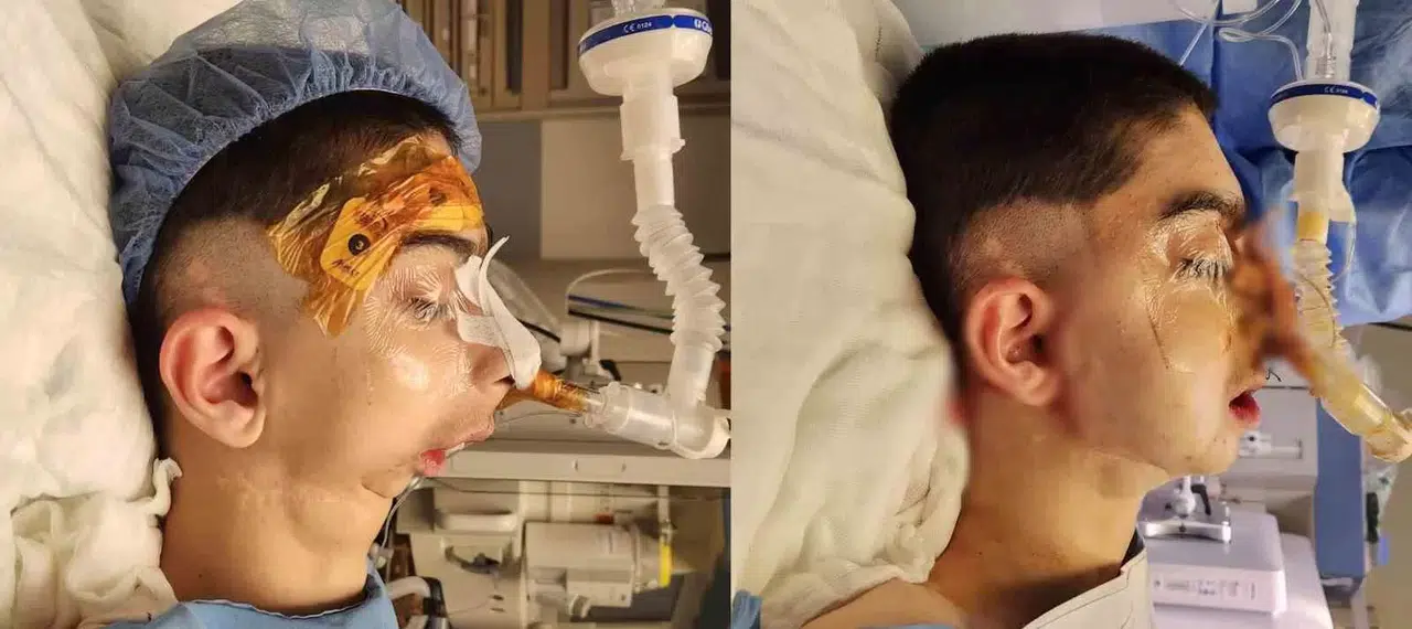 Doğuştan Alt Çenesi Olmayan Çocuğa Başarılı Operasyon: 17 Yıl Sonra Olağan Yemek Yiyebilecek
