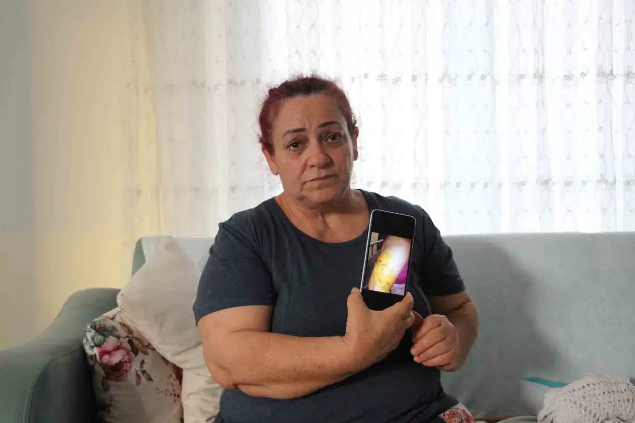 Köpek Hücumunda Yaşadığı Dehşet Anlarını Unutamayan Bayan Tek Başına Sokağa Çıkamıyor