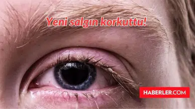 Kırmızı Göz Hastalığı Nedir, Tedavisi Var Mı? Pakistan'da Çıkan Yeni Virüs, Salgın Ne?
