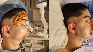 Doğuştan Alt Çenesi Olmayan Çocuğa Başarılı Operasyon: 17 Yıl Sonra Olağan Yemek Yiyebilecek