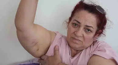 Köpeklerin Saldırısına Uğrayan Bayan: “Ben O An Öldüğümü Sandım”