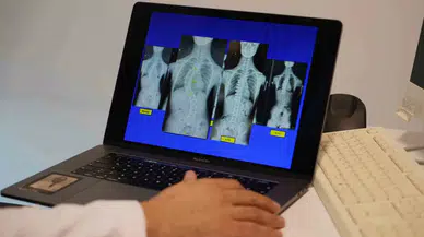 Uzman İsim, Skolyoz Hastası Çocuklar İçin Umut Olan Tedaviyi Anlattı