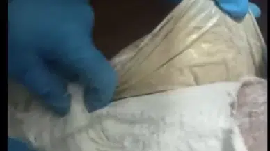 Yolcunun Ayağına Sarılı Alçından Eroin Çıktı