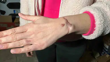 Esenyurt’ta Hoşluk Merkezinde Dövme Sildirme Süreci Yaptıran Bayan: “Kolumu Yaktılar”