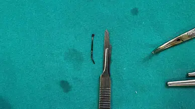 5 Yaşındaki Çocuğun Yuttuğu Toplu İğne Ameliyatla Çıkarıldı