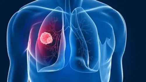 Tüberküloza Karşı Erken Teşhis ve Aşı Uyarısı